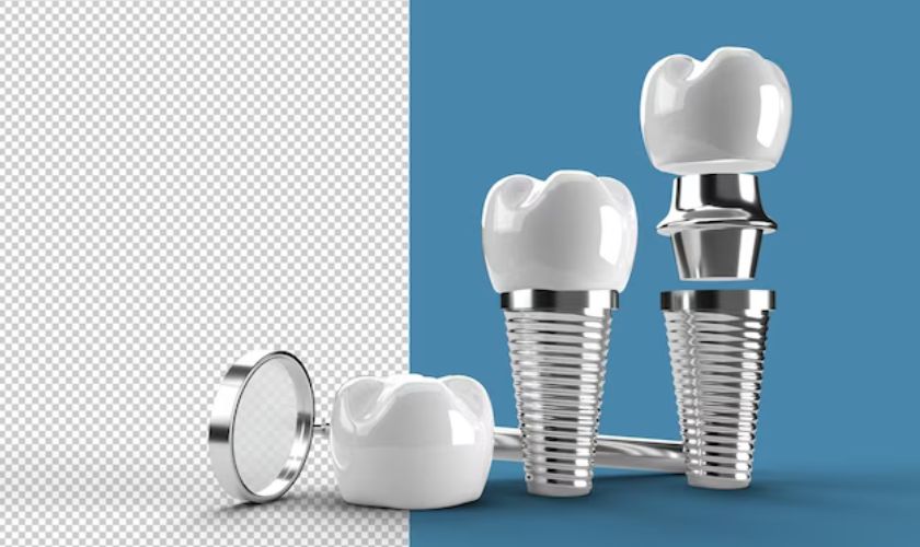 Featured image for “How Dental Implants Can Improve Your Quality of Life”