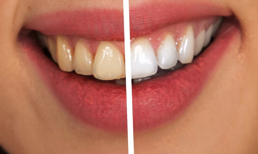 Featured image for “The Ultimate Guide: Does Hydrogen Peroxide Really Whiten Teeth?”