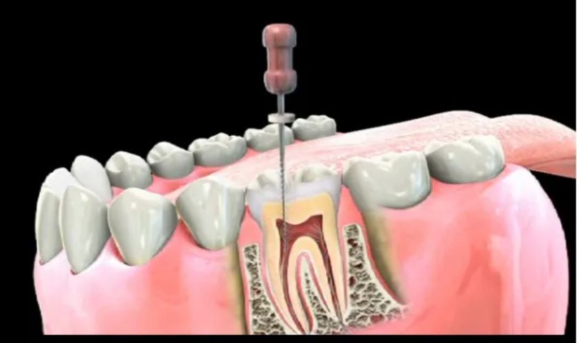 Featured image for “What To Expect After A Root Canal?”