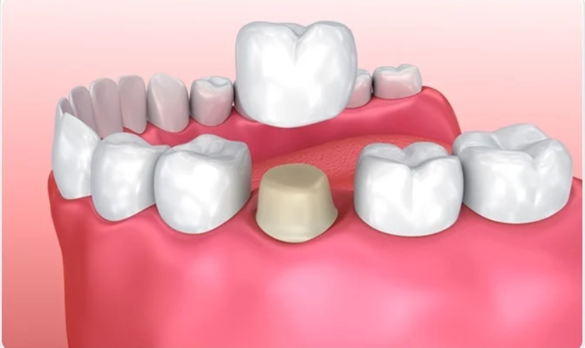Featured image for “Explaining The Gap Behind Your Dental Crown And How To Fix It”