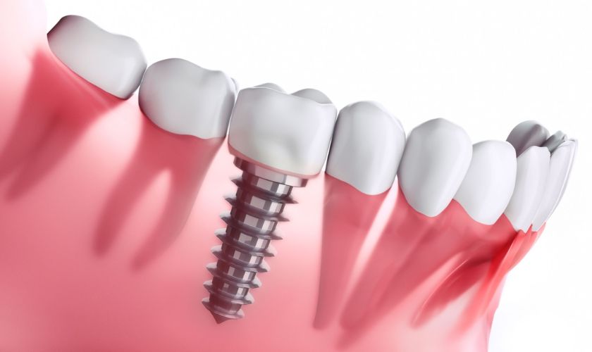 Featured image for “Can Dental Implants Cause Health Issues?”
