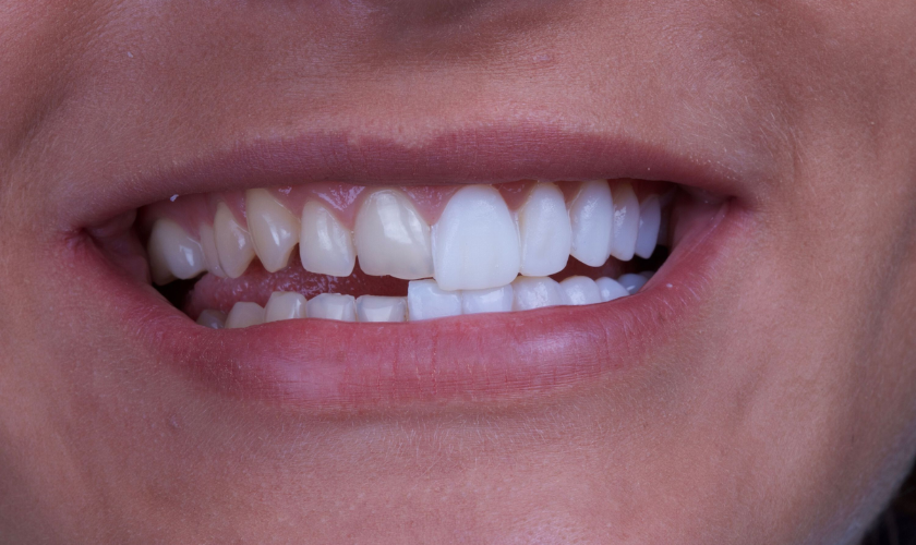 Featured image for “How Long Do Porcelain Veneers Last?”