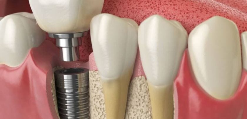 Featured image for “Dental Implant Failure Prevention?”