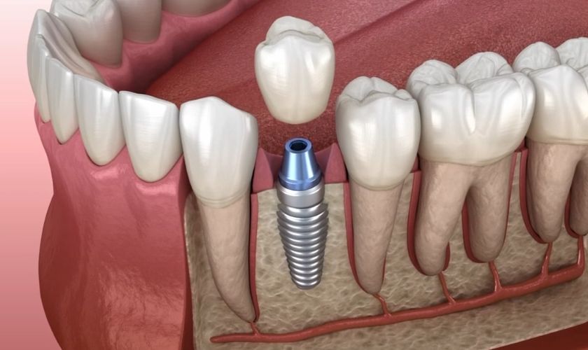 Featured image for “What Are The 3 Stages Of Dental Implant?”